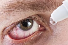 Accutane Side Effects & the Eyes