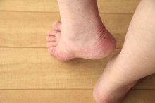 Vitamin D Deficiency & Plantar Fasciitis