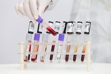 BUN Vs. Serum Creatinine: Which Is Better for Renal Insufficiency?
