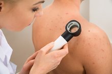 Melanoma Vs. Age Spots