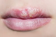 How to Take Lysine for Fever Blisters