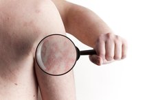 How to Get Rid of Psoriasis & Eczema