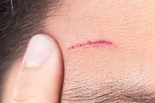 Healing Stages of Scars
