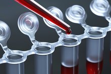 What Happens if You Have High Neutrophils?