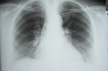 Symptoms of a Broken Sternum