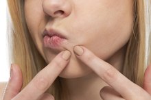Selenium Sulfide for Acne