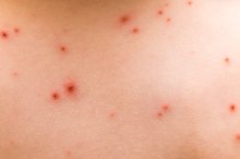 Red Bumps on the Back