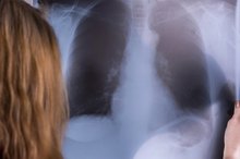 Pancreatic Cancer & Fluid Buildup in the Lungs