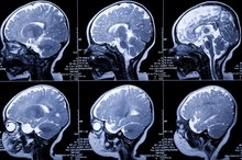 Long-Term Effects of Peripheral Neuropathy