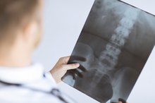 How to Treat Pelvic Hairline Fracture