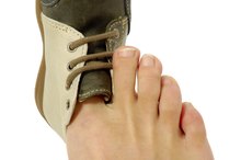 How to Treat an Ingrown Nail