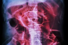 Distended Colon Symptoms