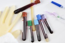 What Does a High Potassium Blood Level Mean?