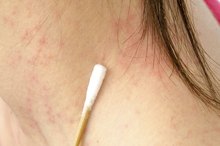 Adrenal Fatigue & Hives