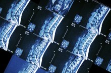 Side Effects of a Bone Scan
