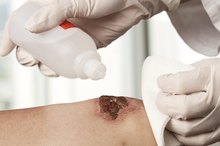 Types of Dressings for Burn Wounds