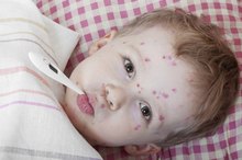 Types of Chicken Pox
