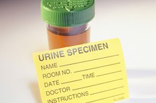 Leukocytes in Urine Without Infection
