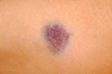 How to Prevent Black and Blue Marks