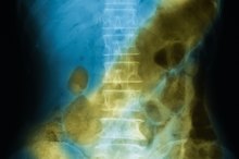 Parasitic Nematodes in Humans