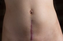 How to Take Away Keloid Scarring