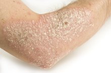 How to Treat Eczema & Psoriasis With Tea