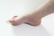 Swollen Ankles and Knees From Running