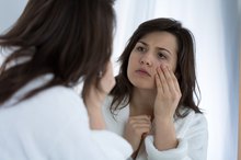 Pathologic Dark Circles Around the Eyes