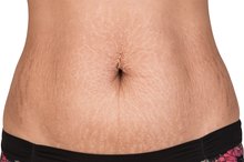 Turmeric for Stretch Marks
