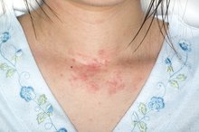 Betaderm Side Effects