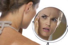 Topical Cortisone for Scars