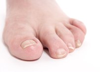 Baking Soda for Ingrown Nail