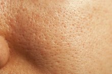 Diet for Clogged Pores