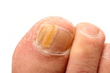 Emu Oil Remedy for Toenail Fungus