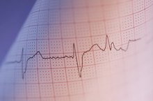 Vitamin Deficiencies & Racing Heart