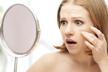 Blackheads That Pop but Keep Coming Back