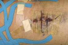Scars After an ACL Repair