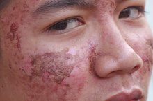 Scalp Pimple Problems for Kids