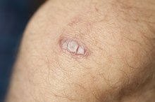 How to Reduce a Keloid