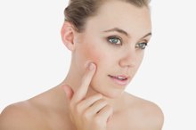 Enlarged Pores in Aging Skin