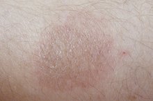 How to Treat a Rug Burn
