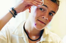 How Can You Tell the Difference Between a Boil and a Pimple?