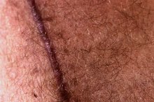How to Massage Scars to Help Heal Them