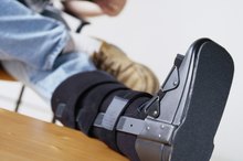 How to Start Walking After Cast Removal