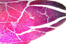 Exercise Limitations With Pancreatitis