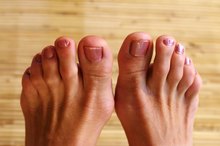How To Make a Bunion Brace
