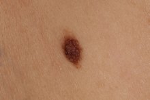 How to Remove Moles With Glycolic Acid