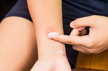 Baking Soda & Water to Remove Skin Tags