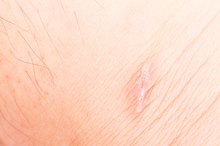 How to Flatten Keloid Scars