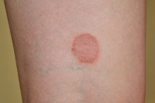 How to Cure Ringworm on Your Lips